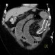 Migration of stent, ileus: CT - Computed tomography